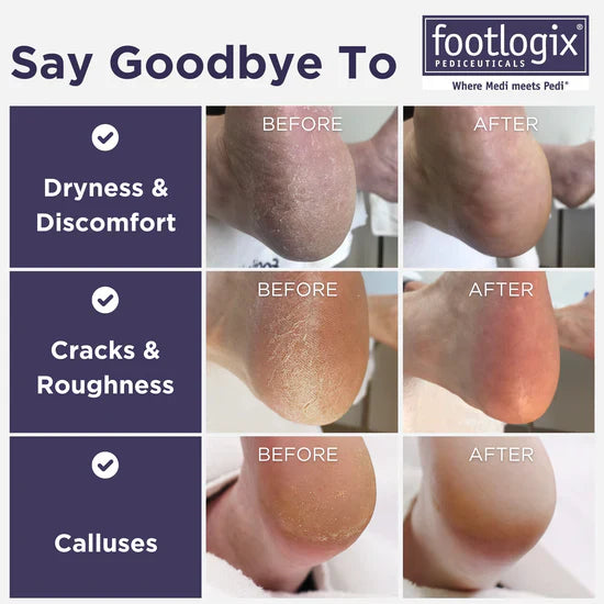 Footlogix Ultimate "At Home" Foot Care Combo (100ml)