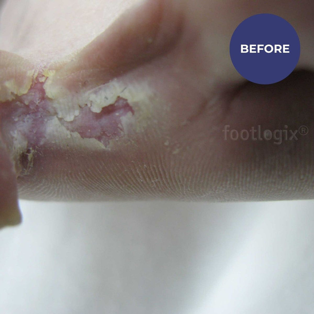Footlogix Peeling Skin Formula (125ml)