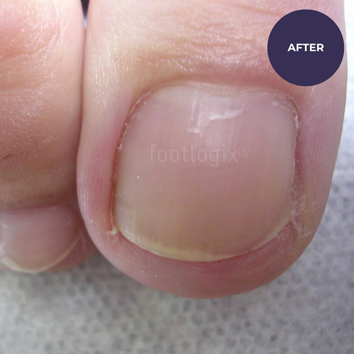 Footlogix Tintura per Unghie dei Piedi (50ml)