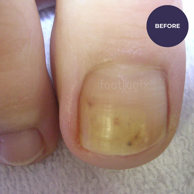 Footlogix Tintura per Unghie dei Piedi (50ml)