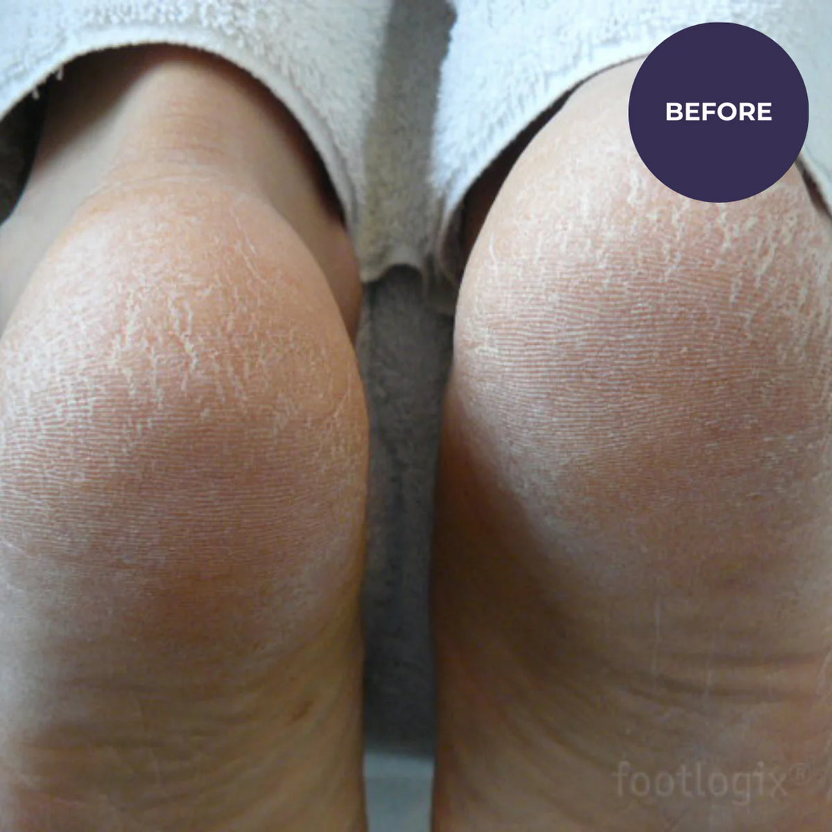 Footlogix Very Dry Skin Formula (125ml)