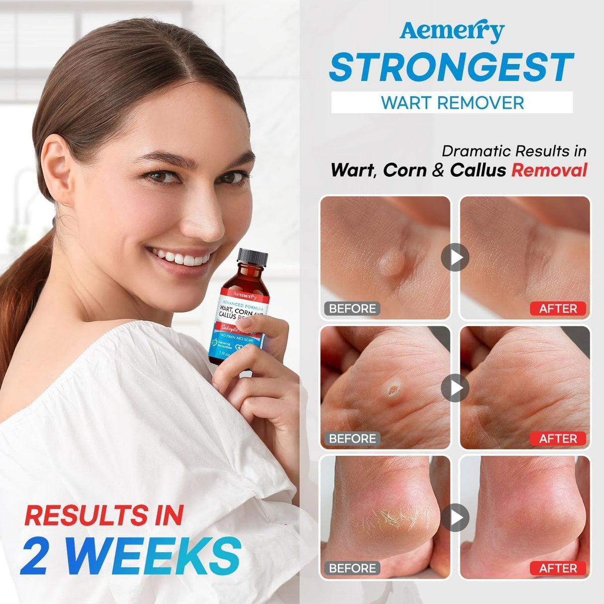 Aemerry Wart Corn Callus Remover β Maximum Strength Liquid Salicylic Acid for Feet (30ml)