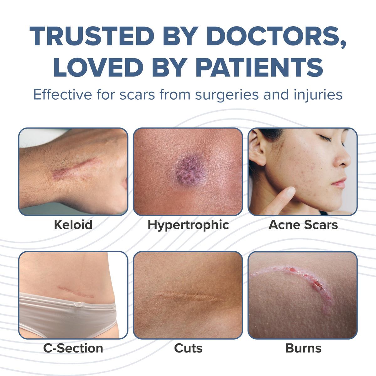 BIODERMIS ProSIL Silicone Scar Stick β Non-Invasive Scar Gel for Surgical, Acne & Burn Scars (17g)