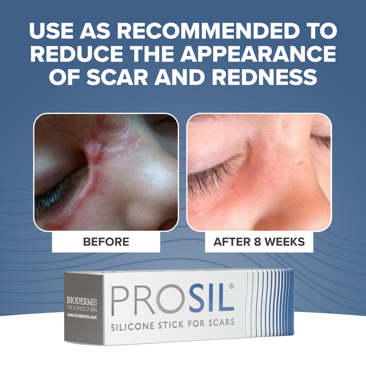 BIODERMIS ProSIL Silicone Scar Stick β Non-Invasive Scar Gel for Surgical, Acne & Burn Scars (17g)