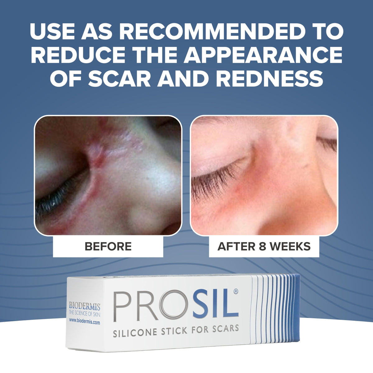 BIODERMIS PROSIL Silicone Scar Stick 4.25g | Glide-On, Mess-Free Scar Care