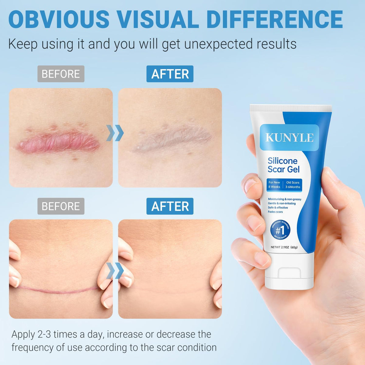 Kunyle Silicone Scar Gel – Advanced Scar Care for Surgical Scars, Keloids, and Stretch Marks | 2.11oz (60g)
