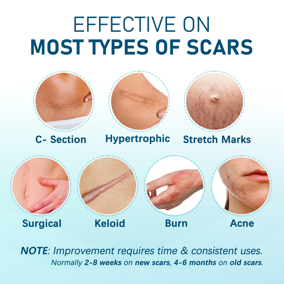 MEDLOT Silicone Scar Sheets β 10pcs Reusable Scar Treatment Strips for Surgical, C-Section, Acne Scars | Breathable & Cut-to-Size