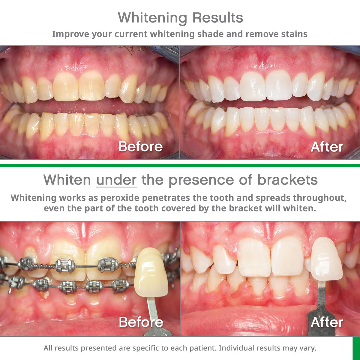 Opalescence Go 10% Mint Teeth Whitening Kit β 10 Treatments GO10-5193-1