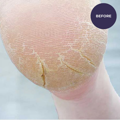 Footlogix Cracked Heel Formula (125ml)