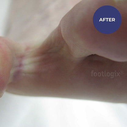 Footlogix Peeling Skin Formula (125ml)