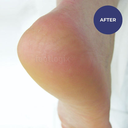 Footlogix Rough Skin Formula (125ml)