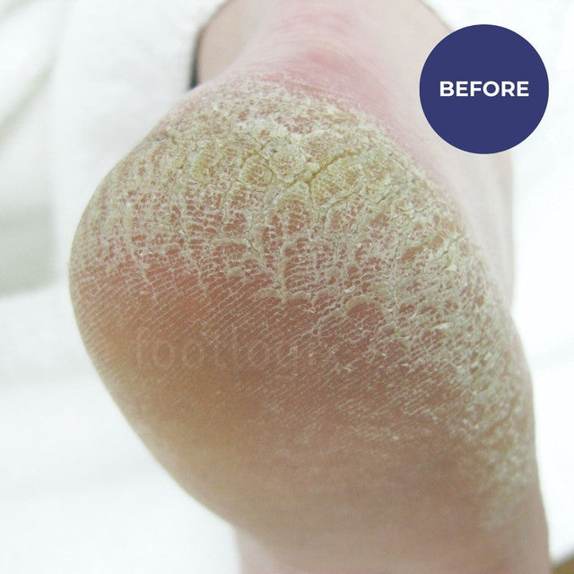 Footlogix Rough Skin Formula (125ml)