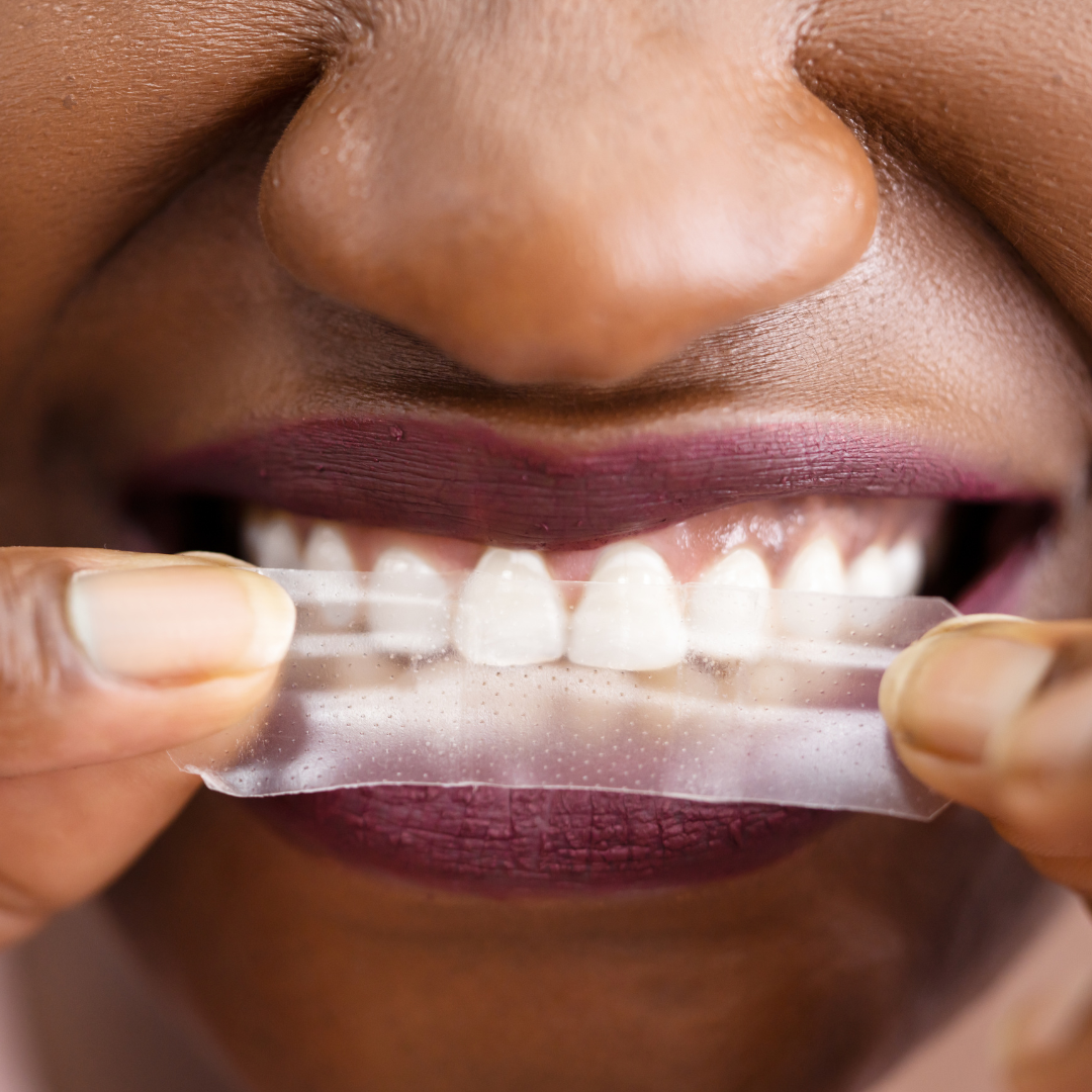 مجموعة تبييض شاملة - شرائط وقلم تبييض الأسنان المتطور PAP-X™