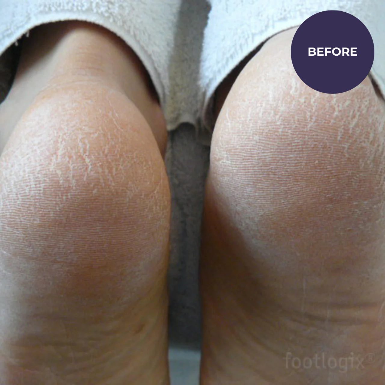 Footlogix Very Dry Skin Formula (125ml)