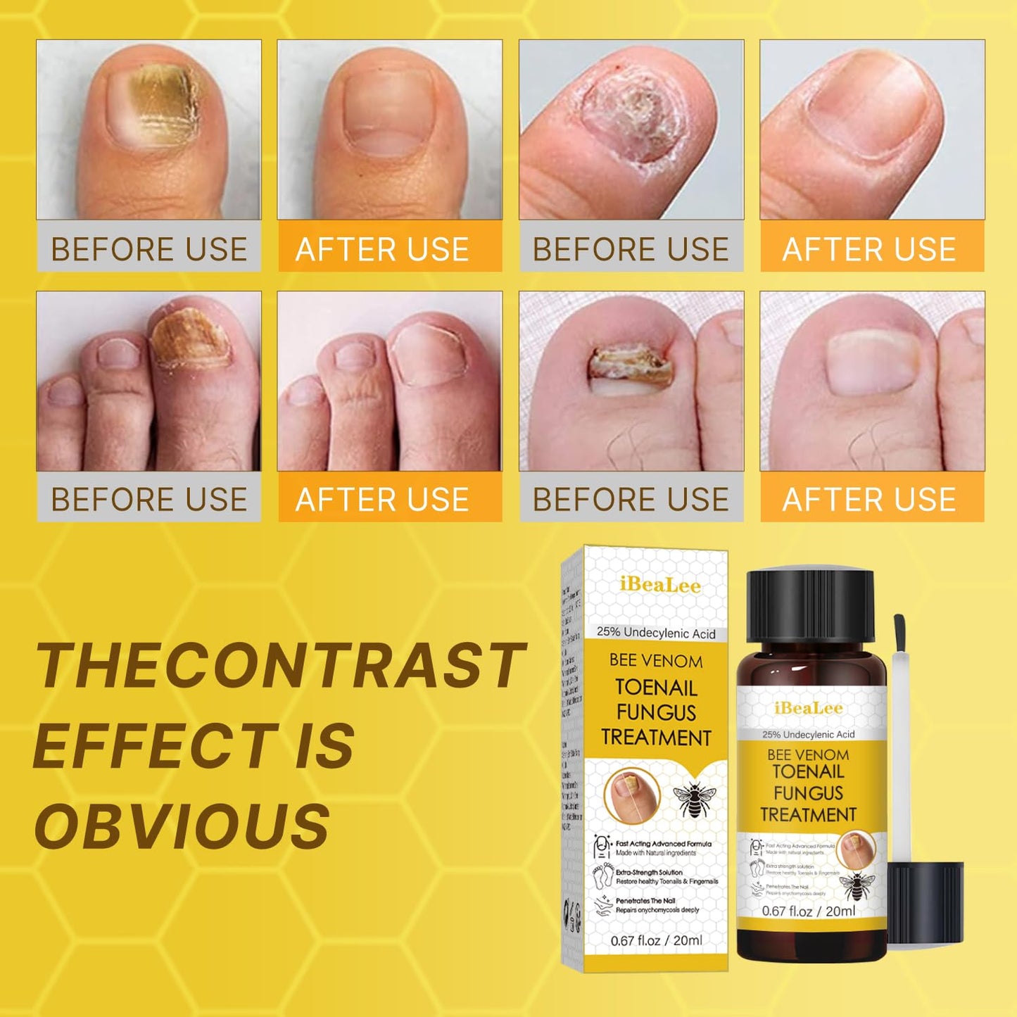 Aimery Bee Venom Antifungal Solution Extra Strength – Toenail & Fingernail Fungus Treatment
