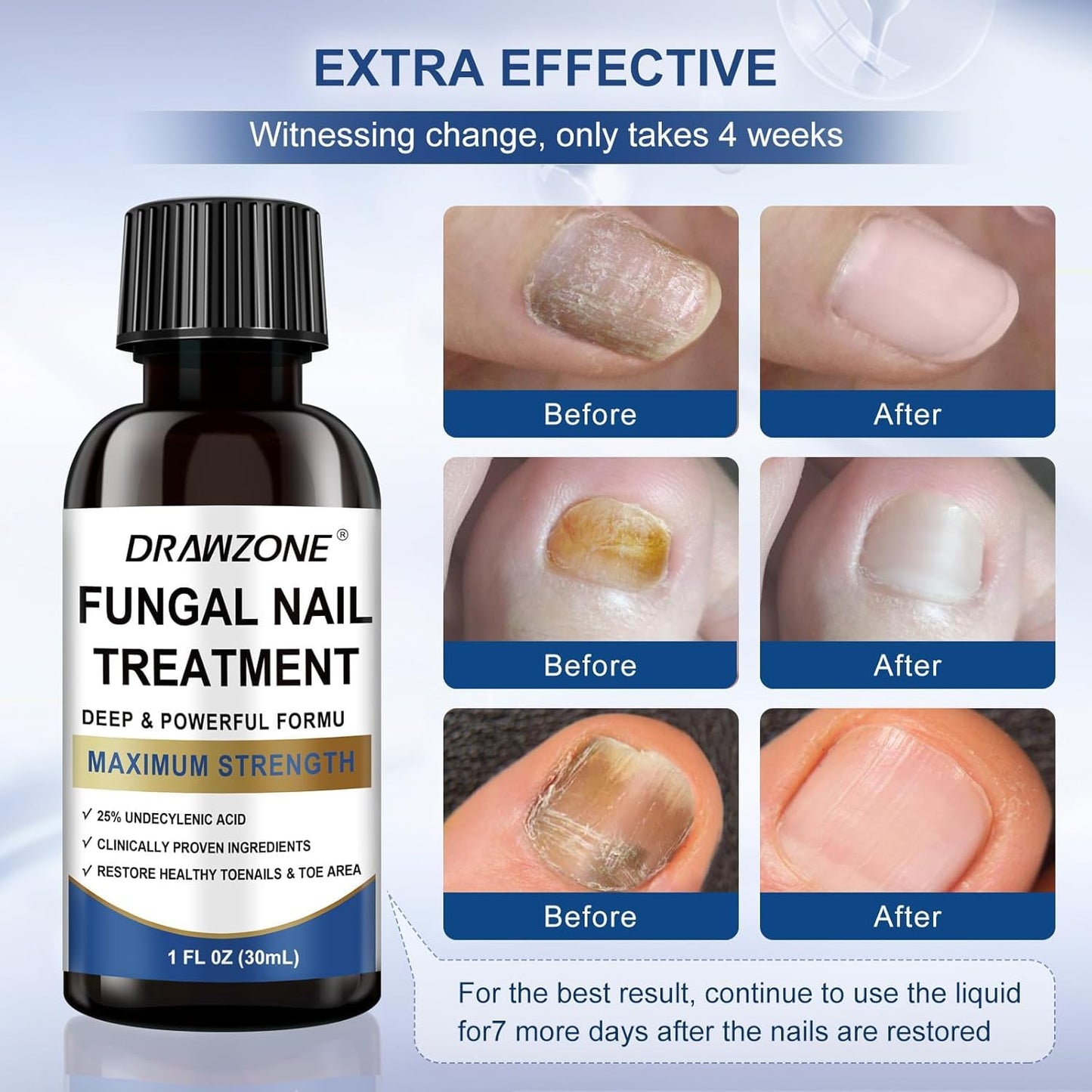 Drawzone Toenail Fungus Treatment Extra Strength – 25% Undecylenic Acid, Nail Renewal