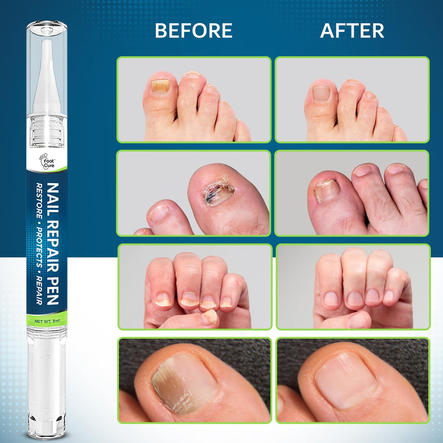 Foot Cure Nail Repair Pen – Extra Strength Toenail Fungus Treatment (USA Made)