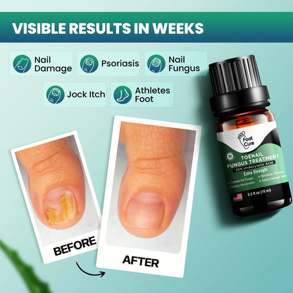 Foot Cure Toenail Fungus Treatment Extra Strength – Athletes Foot & Damaged Nail Repair | Made in USA