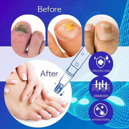 NEOMEN Nail Fungus Pen – Fungal Nail Repair for Toenails & Fingernails