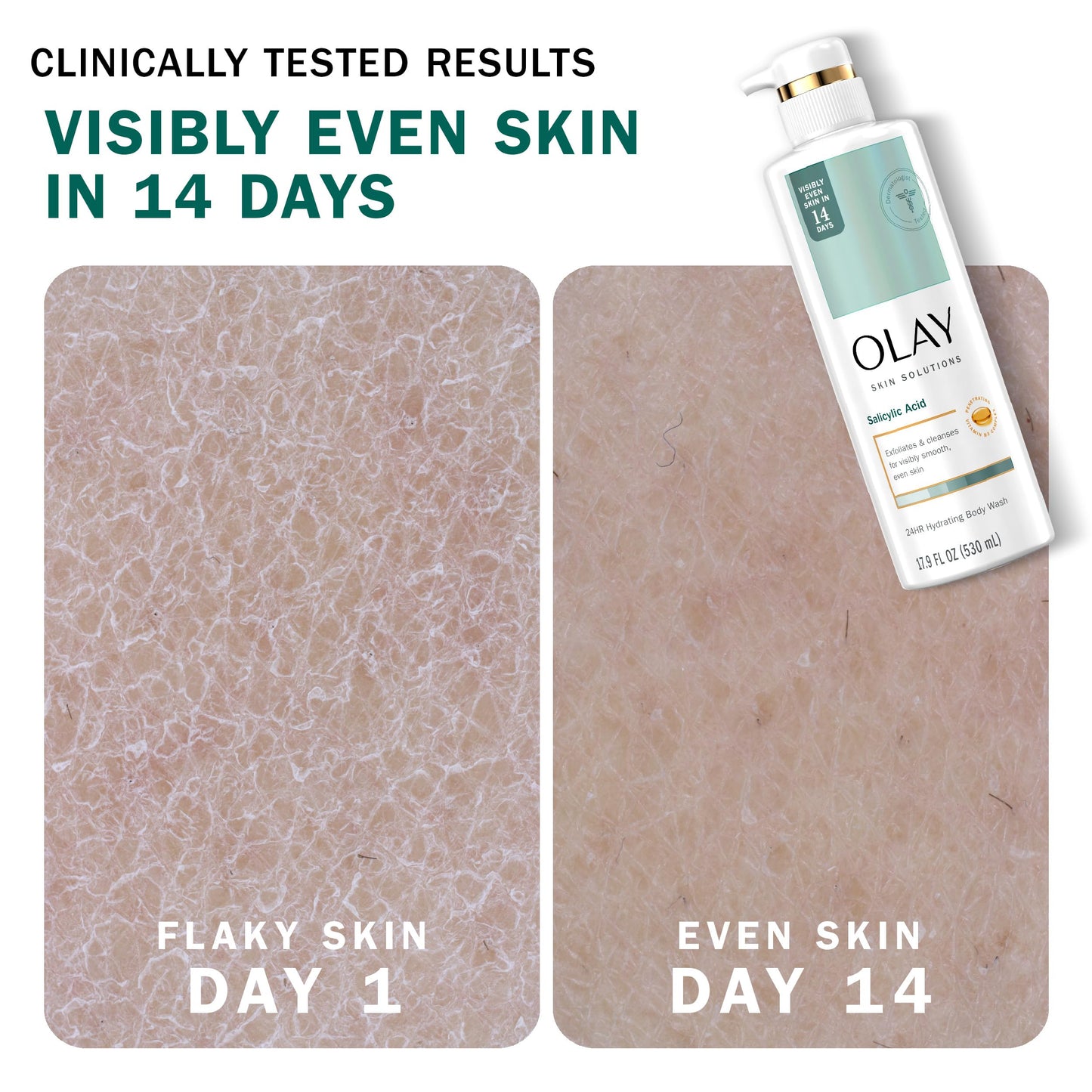 Olay Skin Solutions Hydrating Body Wash with Salicylic Acid – 4 x 17.9 fl oz