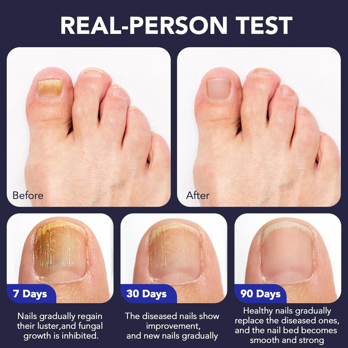 OMZOK Toenail Fungus Pen - 25% Undecylenic Acid & Tea Tree Oil - Extra-Strength Nail Repair (5-Pack)