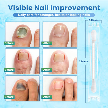 ONIADBA Fungal Nail Treatment Swabs – 100 Ct Extra Strength Toenail & Athlete’s Foot with 25% Undecylenic Acid