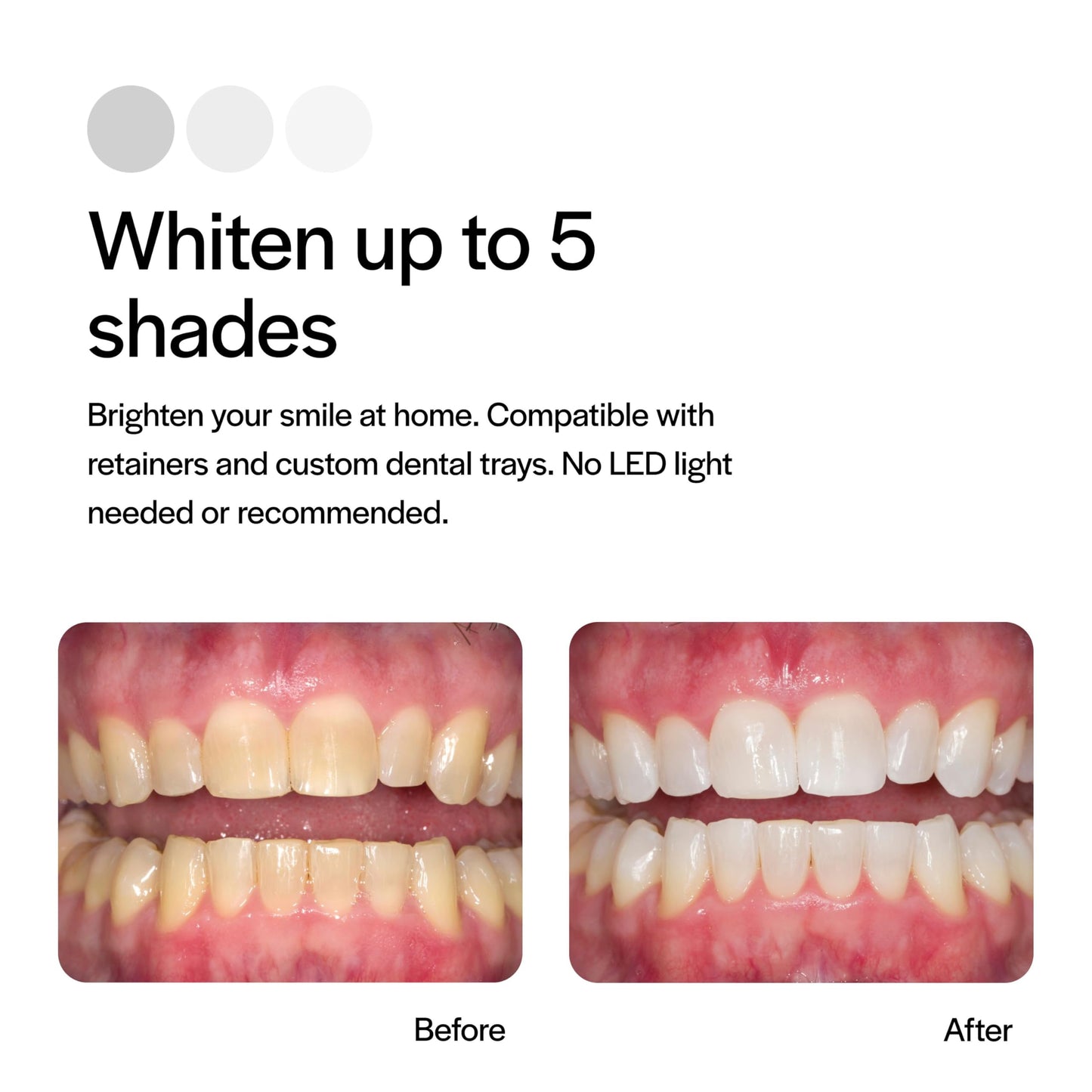 Opalescence 10% Teeth Whitening Kit – Low Sensivity, 4 Syringes Refills – Made in USA by Ultradent 5211-2