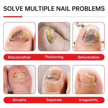 QQE Nail Fungus Treatment Extra Strength - 25% Undecylenic Acid