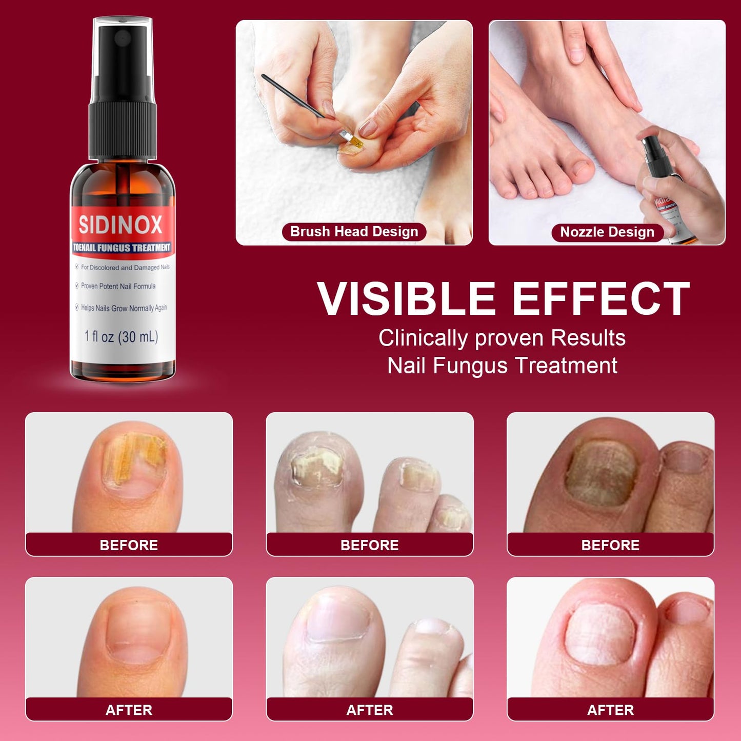 Sidinox Toenail Fungus Treatment Extra Strength with 25% Undecylenic Acid — 5 Pack