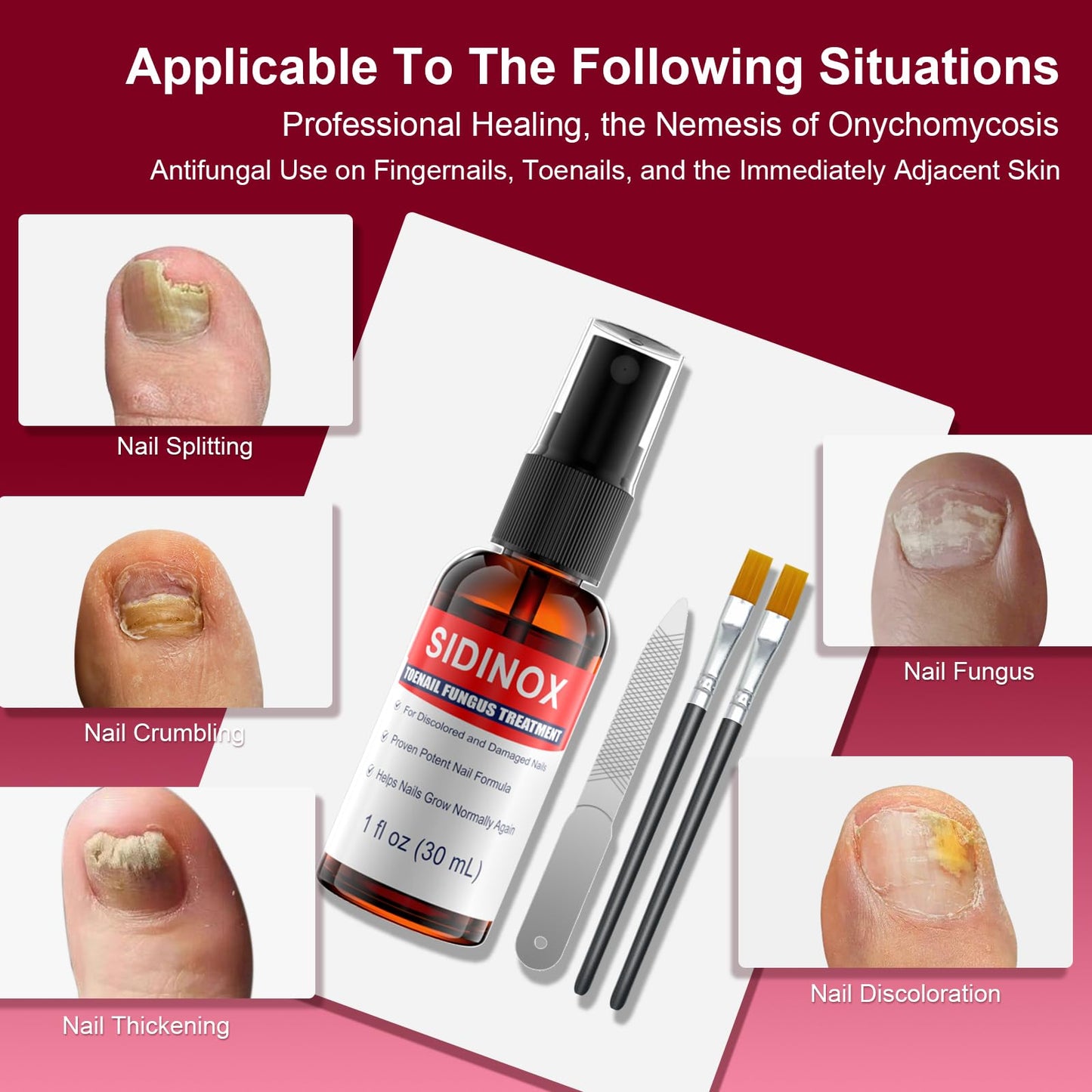 Sidinox Toenail Fungus Treatment Extra Strength with 25% Undecylenic Acid — 5 Pack