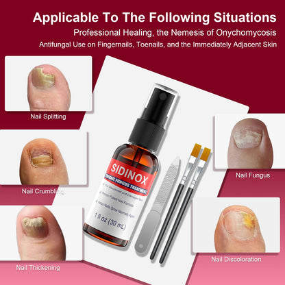 Sidinox Toenail Fungus Treatment Extra Strength with 25% Undecylenic Acid — 5 Pack