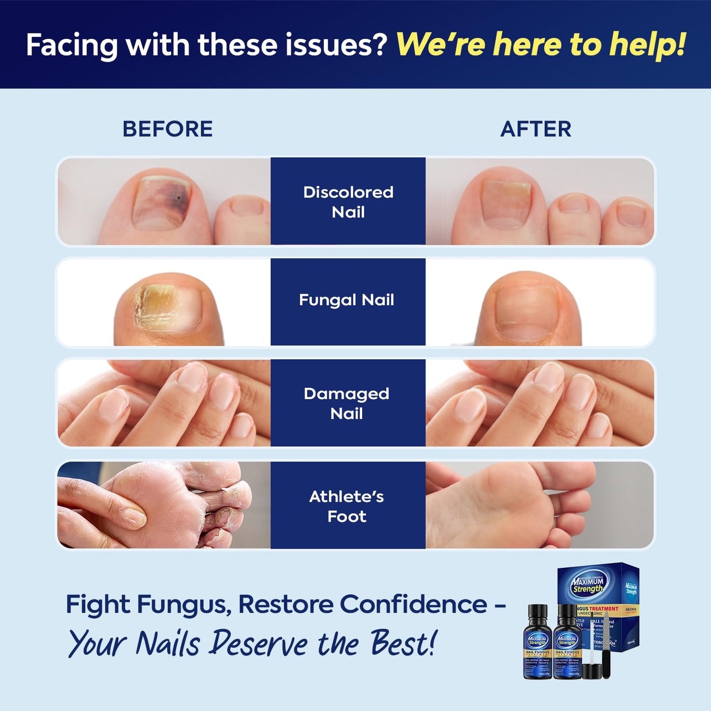 Tobcharm Toenail Fungus Treatment - 25% Undecylenic Acid, Extra Strength (2pcs)