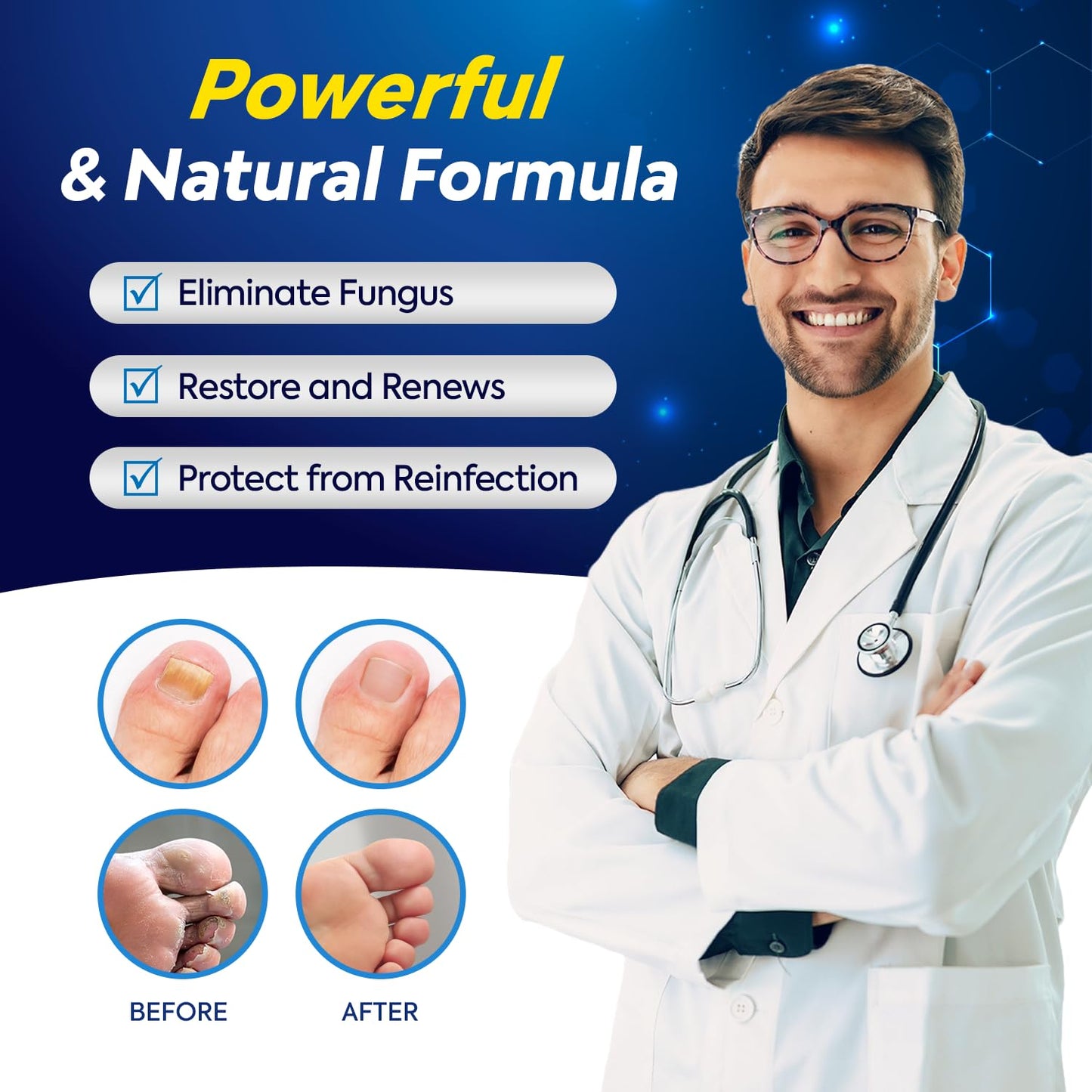 Tobcharm Toenail Fungus Treatment - 25% Undecylenic Acid, Extra Strength (2pcs)