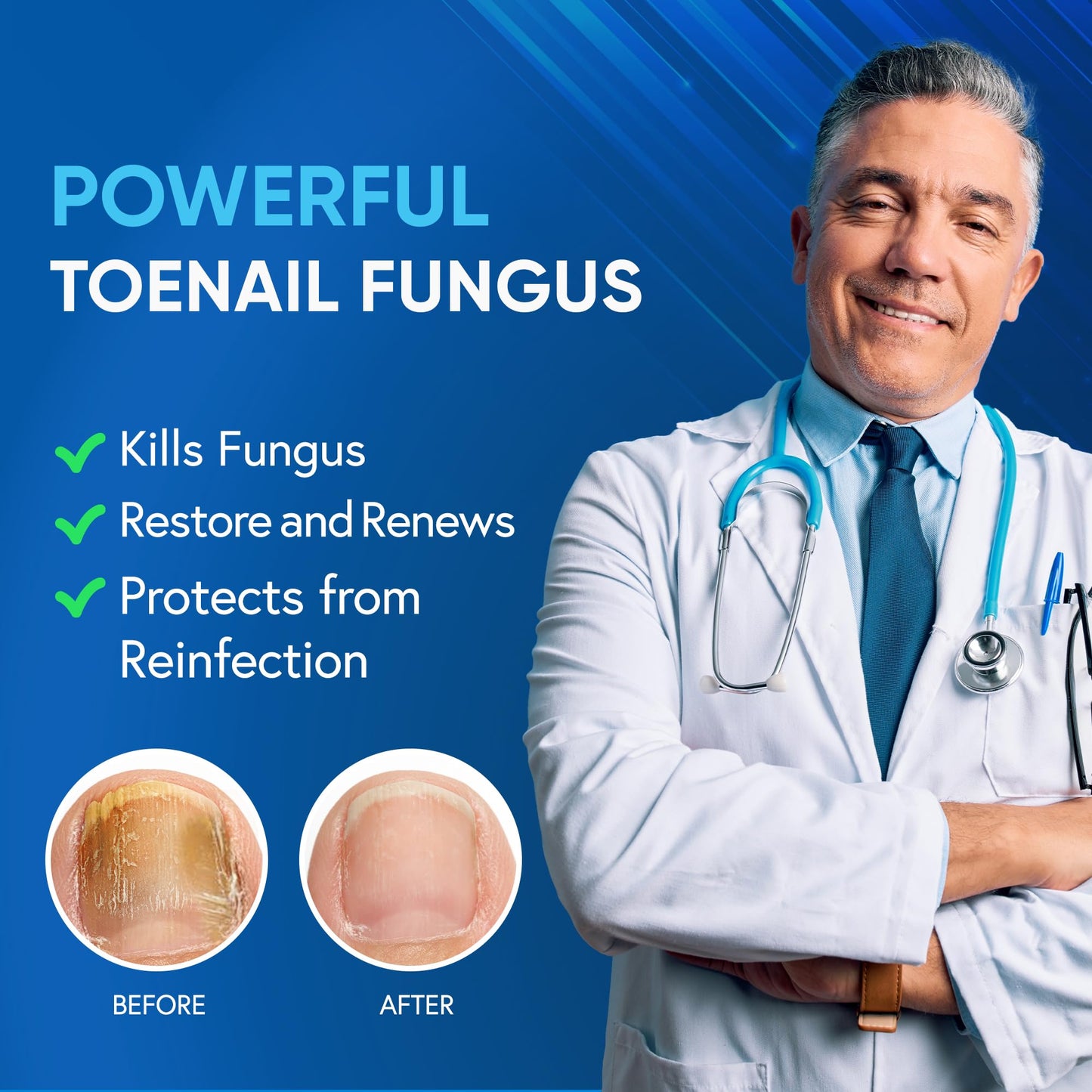 Tobcharm Toenail Fungus Treatment Extra Strength – Tea Tree Oil & 25% Undecylenic