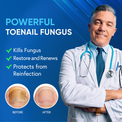 Tobcharm Toenail Fungus Treatment Extra Strength – Tea Tree Oil & 25% Undecylenic