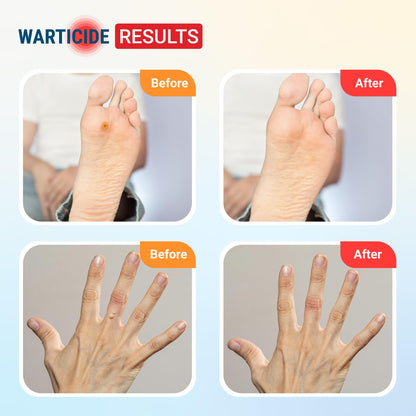 Warticide Liquid Wart Remover – 10% Salicylic Acid with Tea Tree & Cedar Leaf Oil | Made in USA | 1 Fl Oz Dropper